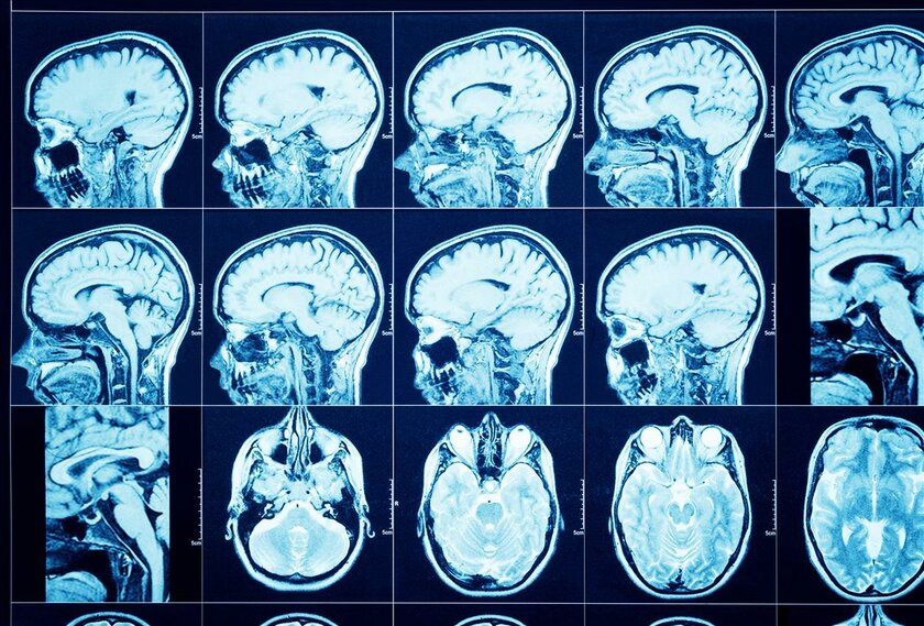 Нейросеть для травматолога: ИИ автоматически распознает черепно-мозговые травмы