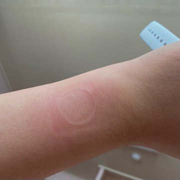 Фото: Apple Watch SE перегреваются, плавя экран и оставляя следы на руке
