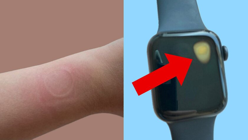 Фото: Apple Watch SE перегреваются, плавя экран и оставляя следы на руке