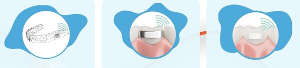 Создан микрочип с Bluetooth и Zigbee. Он встраивается в зубы, но зачем?